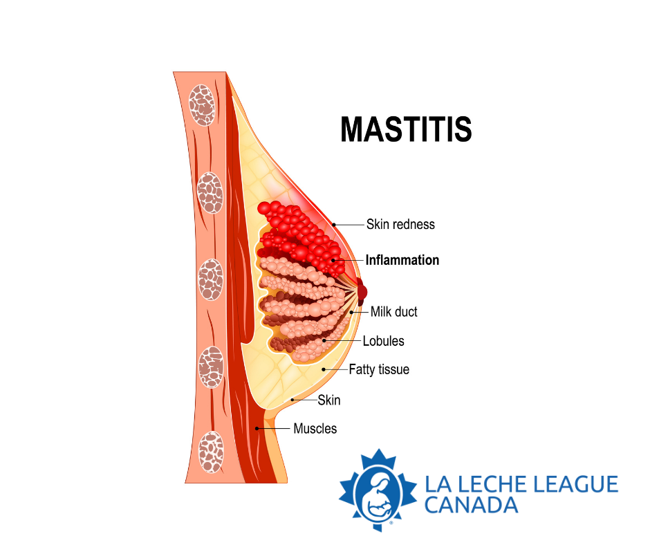 Mastitis - a Matter of Inflammation  La Leche League Canada -  Breastfeeding Support and Information
